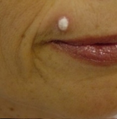 Benign Skin Lesion Removal with Cryopen Fordingbridge Ringwood Salisbury Hampshire