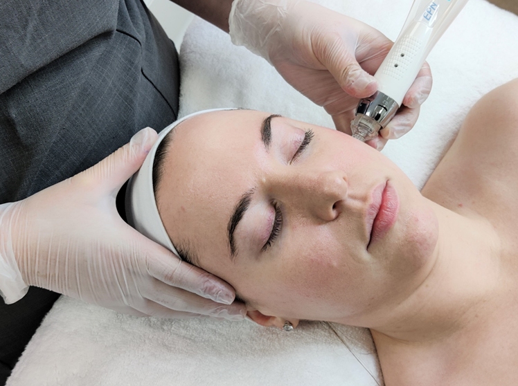 EPN Microneedling Fordingbridge Ringwood Salisbury Hampshire