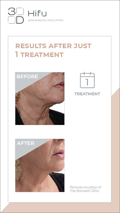 non-surgical facelift Fordingbridge Ringwood Salisbury Hampshire