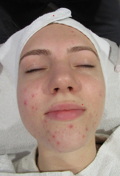 acne treatments Fordingbridge Ringwood Salisbury Hampshire