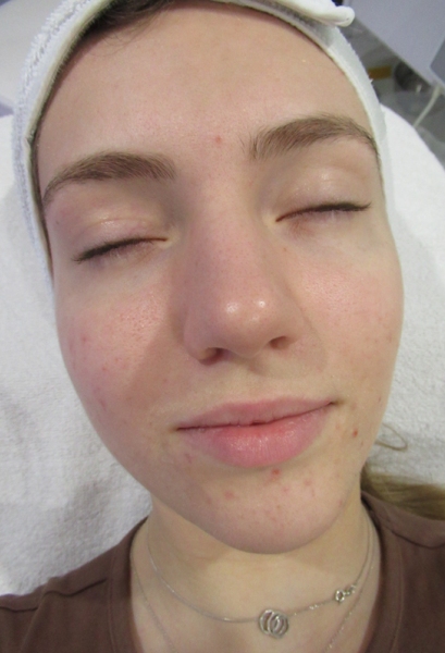 acne treatments Fordingbridge Ringwood Salisbury Hampshire