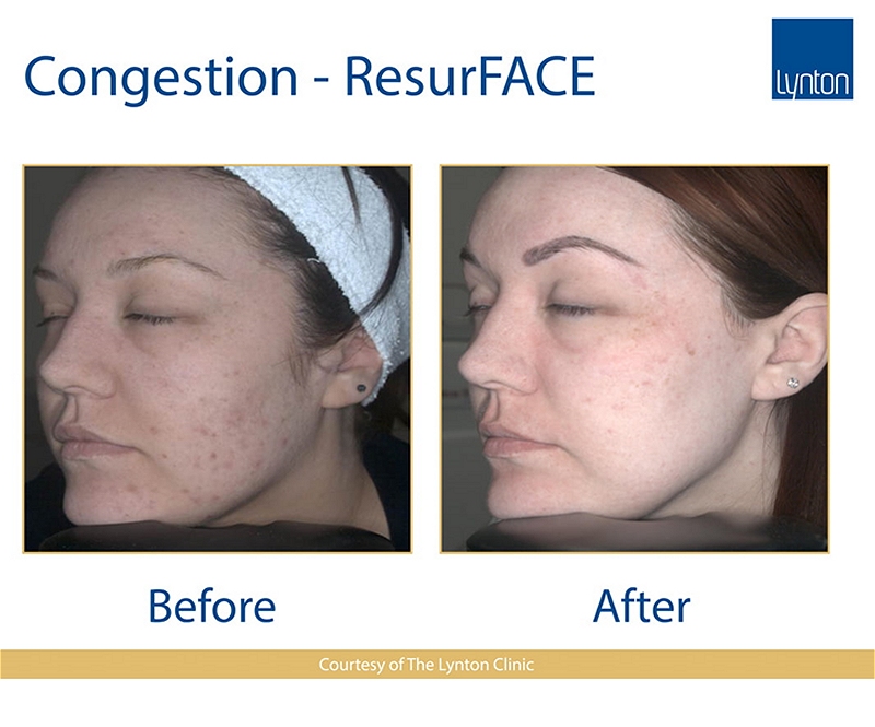 resurface treatments Fordingbridge Ringwood Salisbury Hampshire