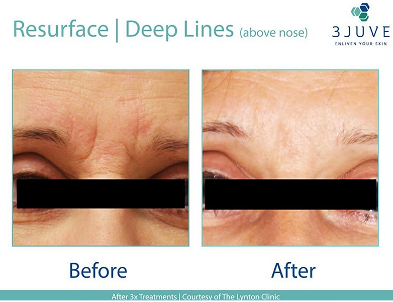 resurface treatments Fordingbridge Ringwood Salisbury Hampshire